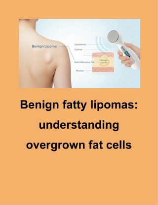 New Treatment for Lipoma – Modern, Non-Invasive Lipoma Wand Solution