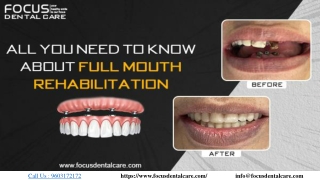 Full Mouth Rehabilitation : All You Need To Know About