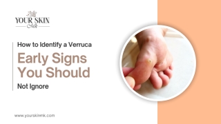 How to Identify a Verruca Early Signs You Should Not Ignore